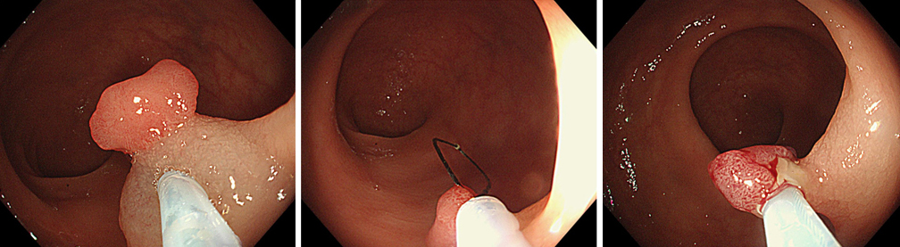 日帰りでの早期大腸がん・ポリープ切除手術