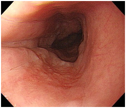 NBI(特殊強調画像システム)を採用