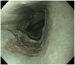 NBI(特殊強調画像システム)を採用