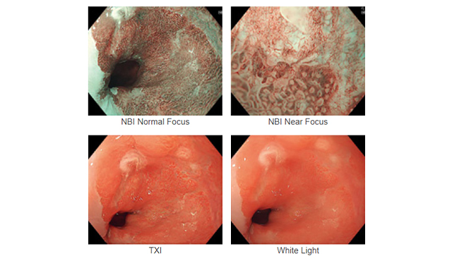NBI(特殊強調画像システム)を採用
