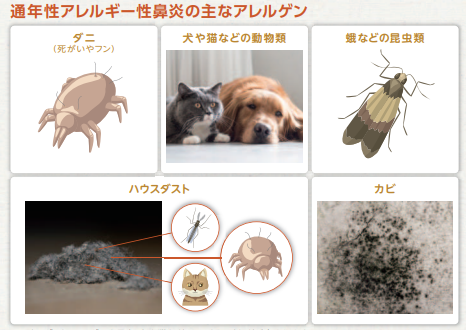 アレルギー性鼻炎(通年性アレルギー性鼻炎)