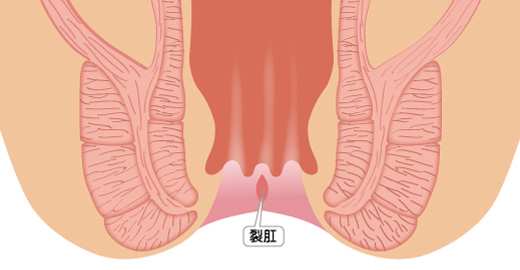 裂肛(切れ痔)