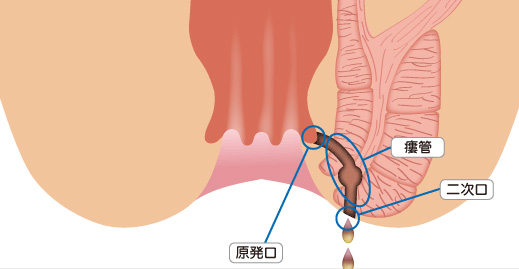 痔瘻(あな痔)