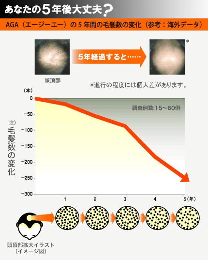 AGAの5年間の毛髪数の変化