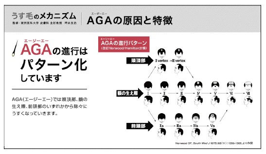 AGAの進行パターン