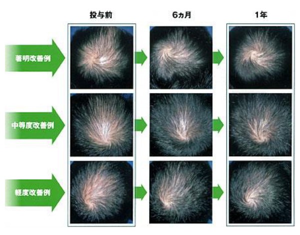 ザガーロの効果実感